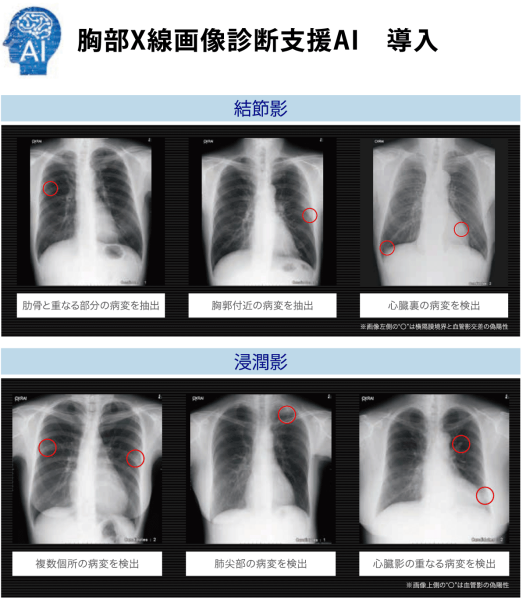 胸部X線画像診断支援AI導入